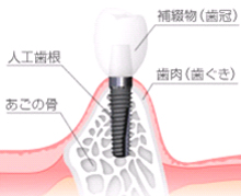 インプラントとは？