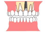 インプラント治療