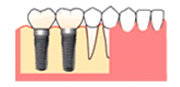 インプラント治療
