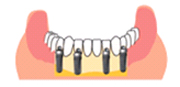 インプラント治療