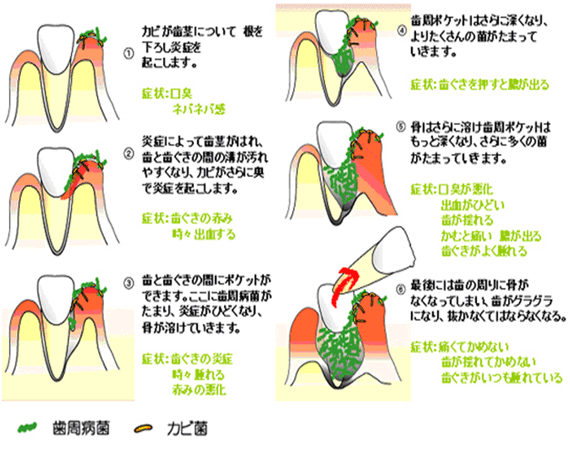 歯周病の進行の流れ