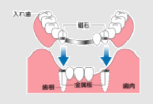 アタッチメント義歯