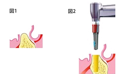 埋入術　図1、図2