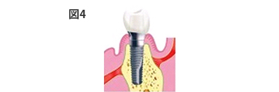 埋入術　図4