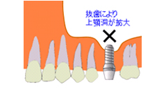 1．骨の厚みが足りない状態