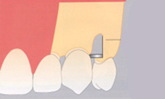 1．インプラント体の埋入