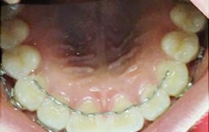 歯に固定するタイプ