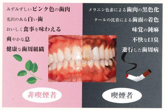 禁煙のススメ