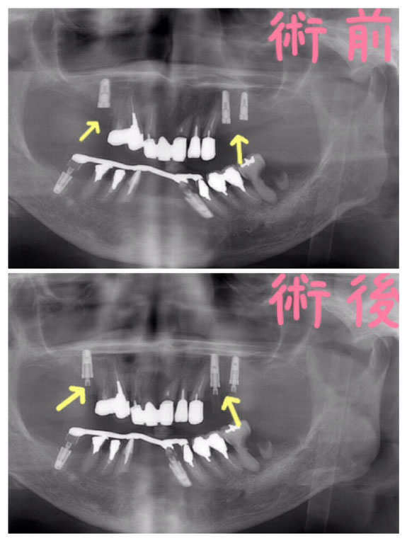 術前　術後