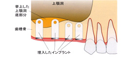 サイナスリフト