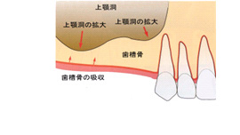 サイナスリフト