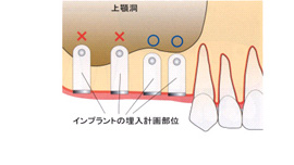 サイナスリフト